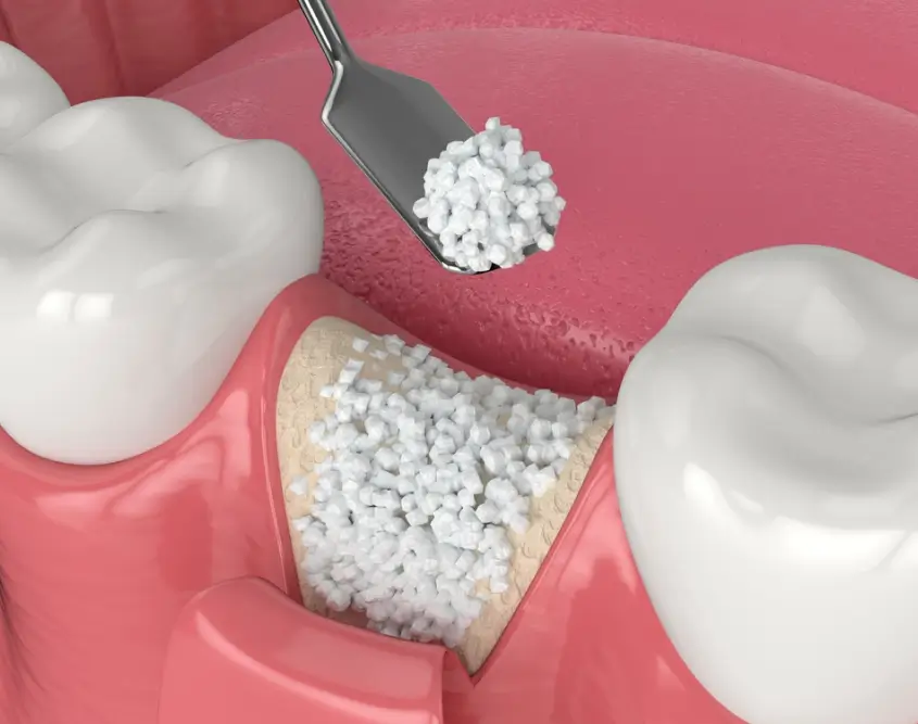 Dental Implants Macquarie Park