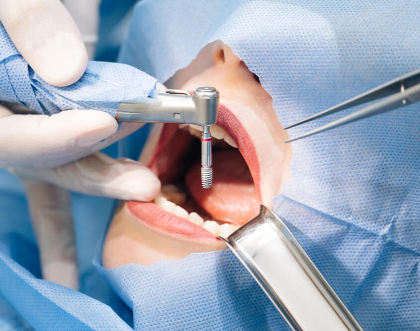 Root Canal Springvale